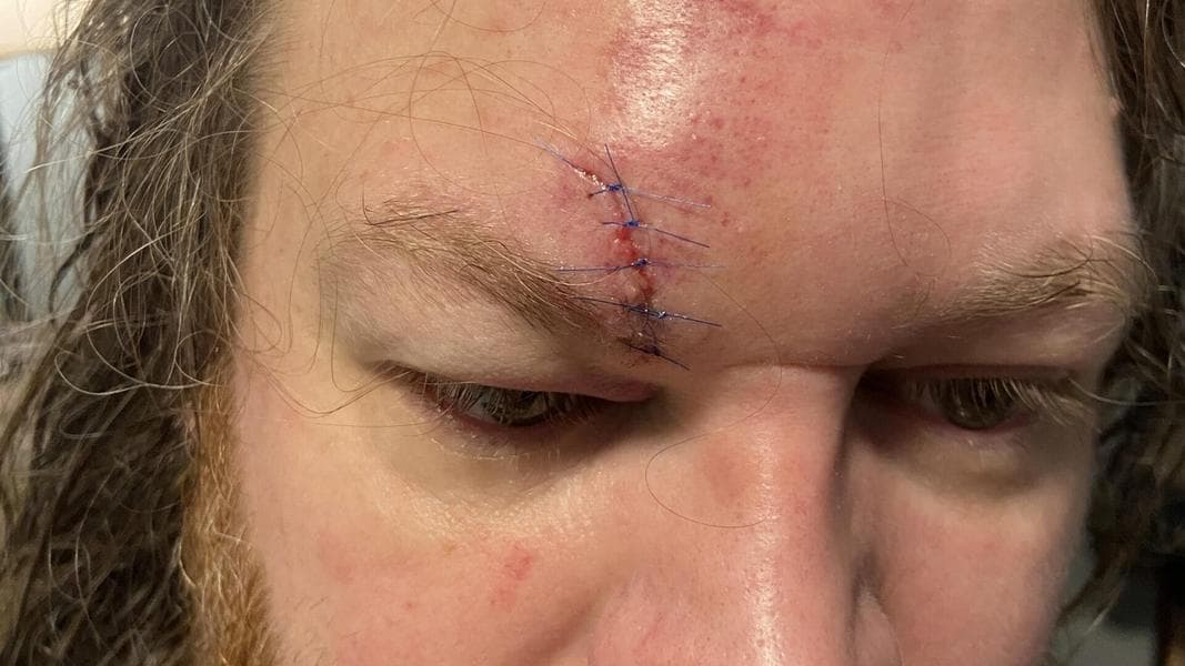 Disneyland Guest Gets Four Stitches After Getting Attacked by Line Cutter
